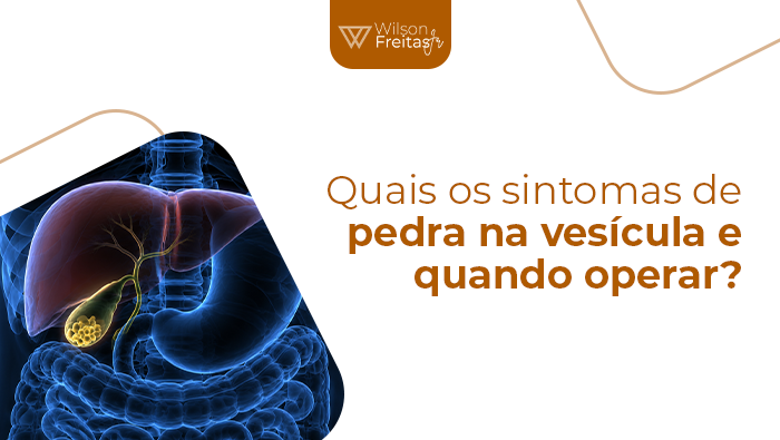 Quais os sintomas de pedra na vesícula e quando operar? Ilustração anatômica do sistema digestivo com fígado, estômago, vesícula biliar e vias biliares em destaque, mostrando cálculos no interior da vesícula biliar.